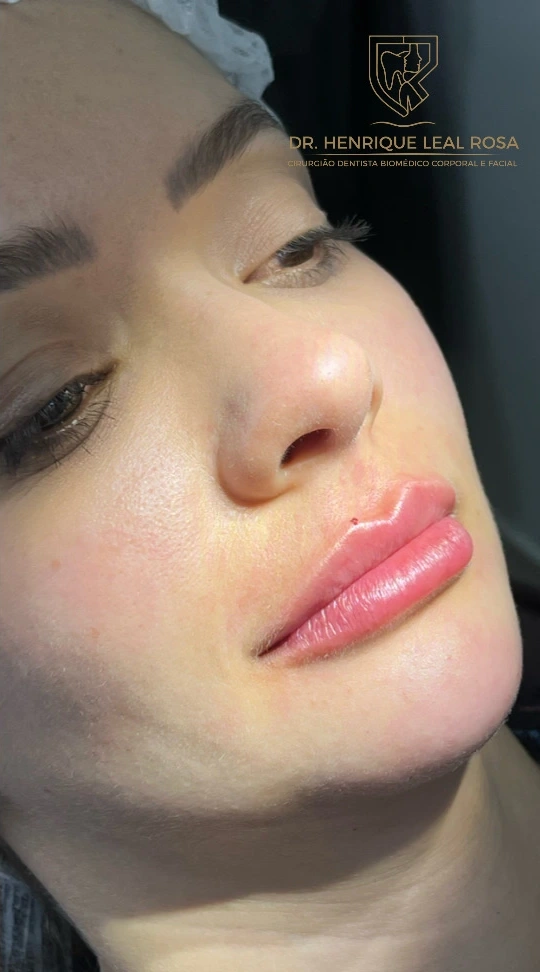 Resultado Real Preenchimento Labial, Dr. Henrique Leal