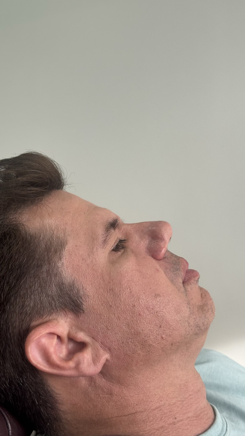 Antes — Preenchimento de Mento e Queixo