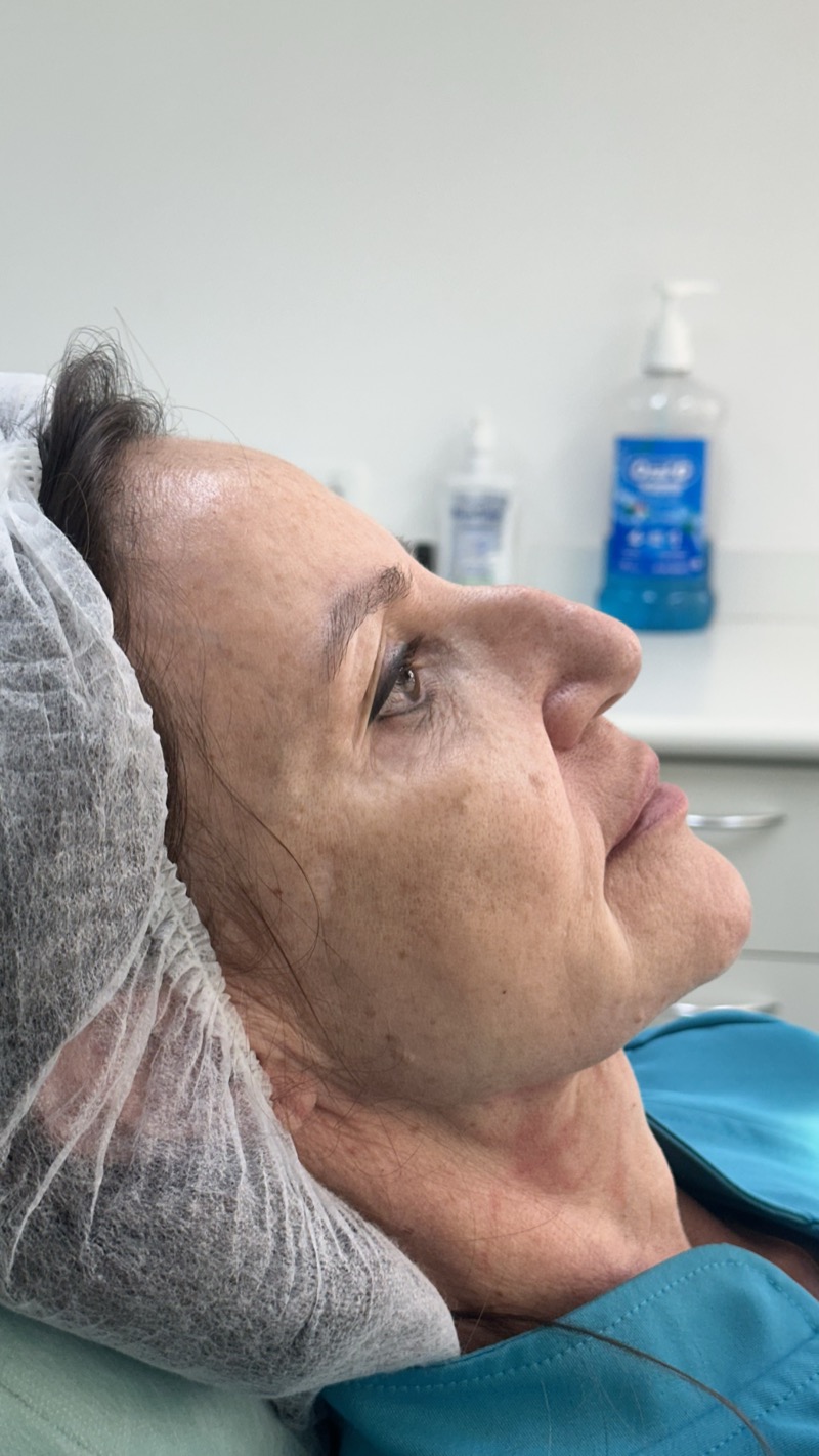 Antes — Rinomodelação