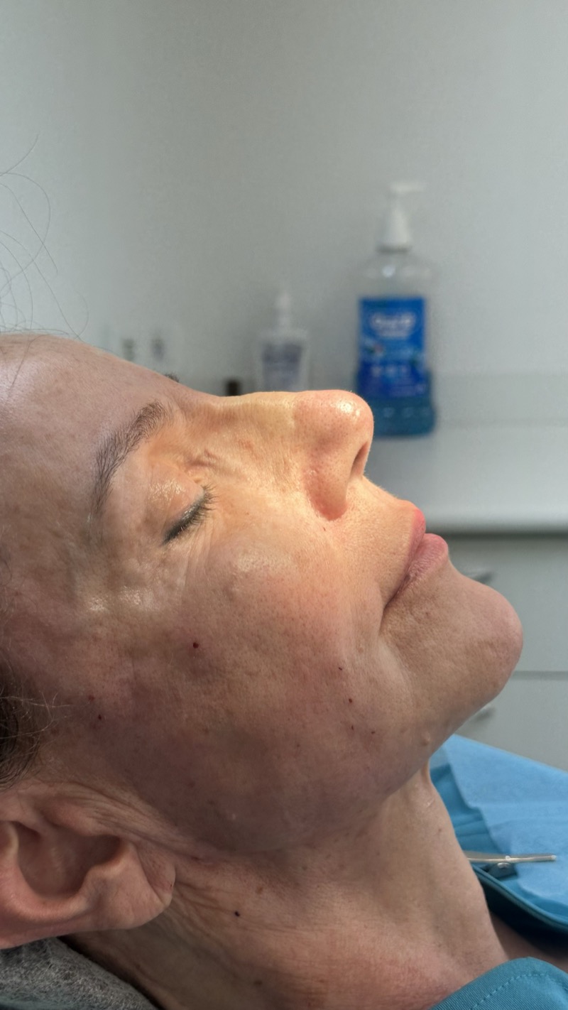 Depois — Rinomodelação