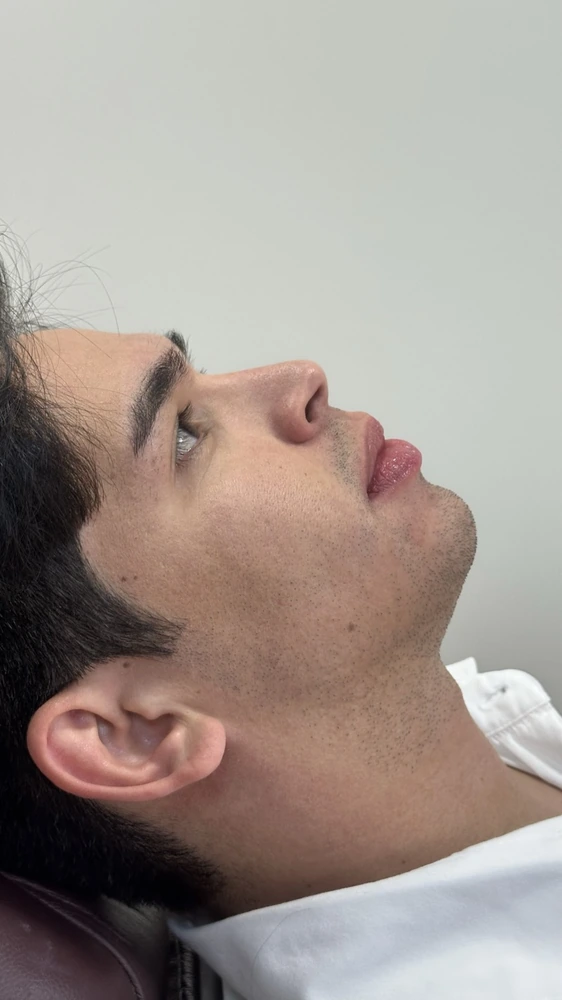 Densidade capilar recuperada com estímulo folicular