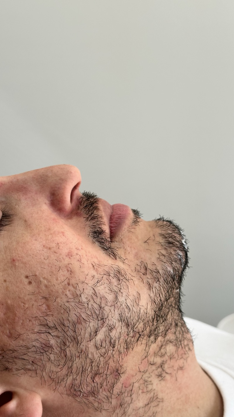 Antes — Preenchimento de Mento