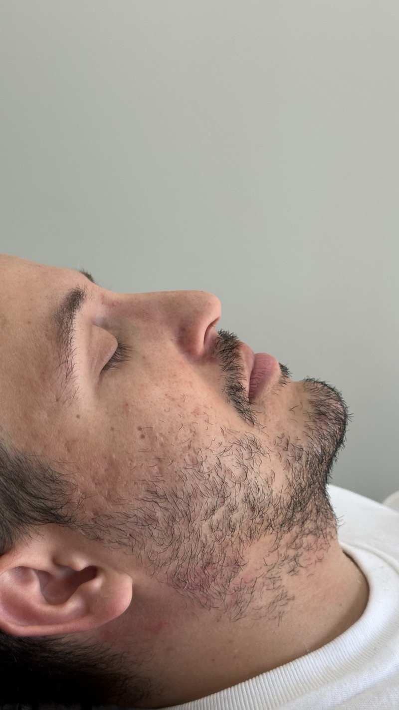 Depois — Preenchimento de Mento