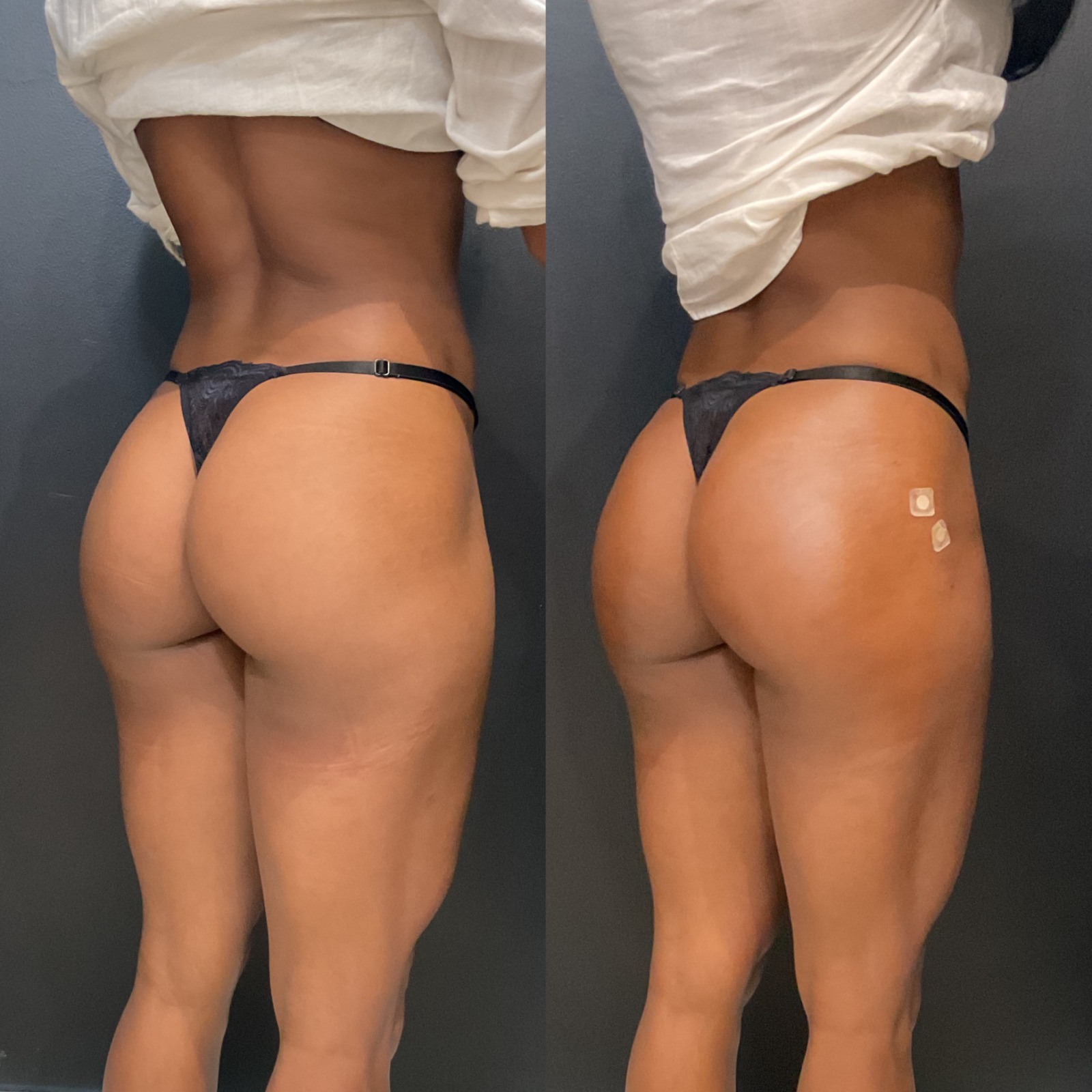 Harmonização Glútea — Antes e Depois