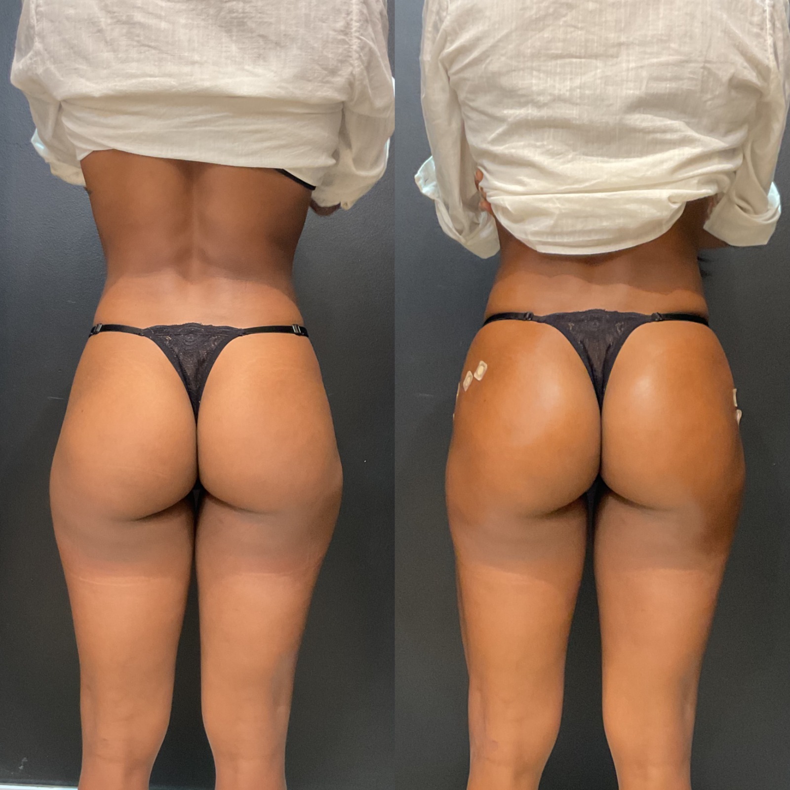 Harmonização Glútea — Antes e Depois