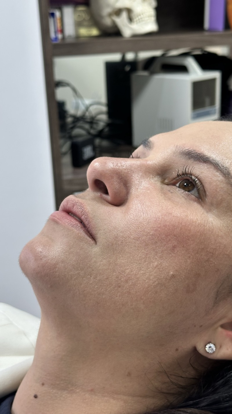 Antes — Preenchimento Labial