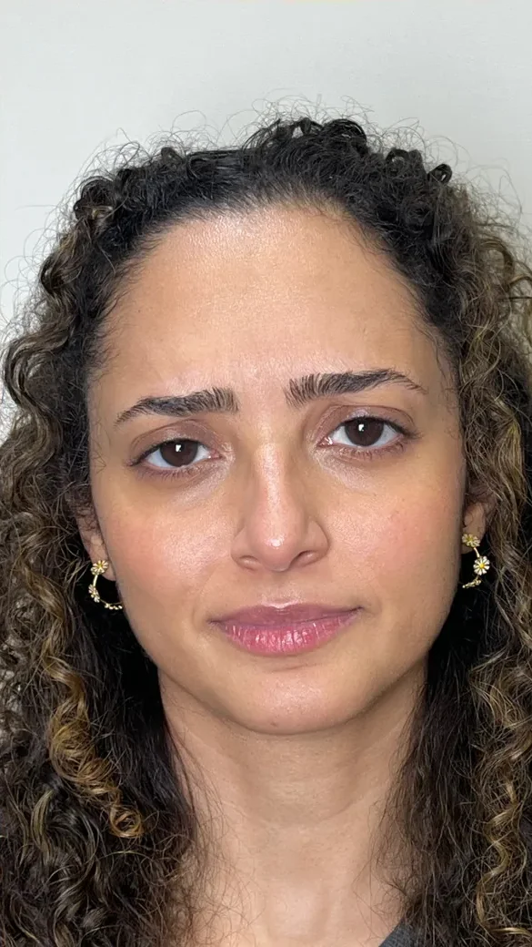 Suavização das rugas da glabela com toxina botulínica