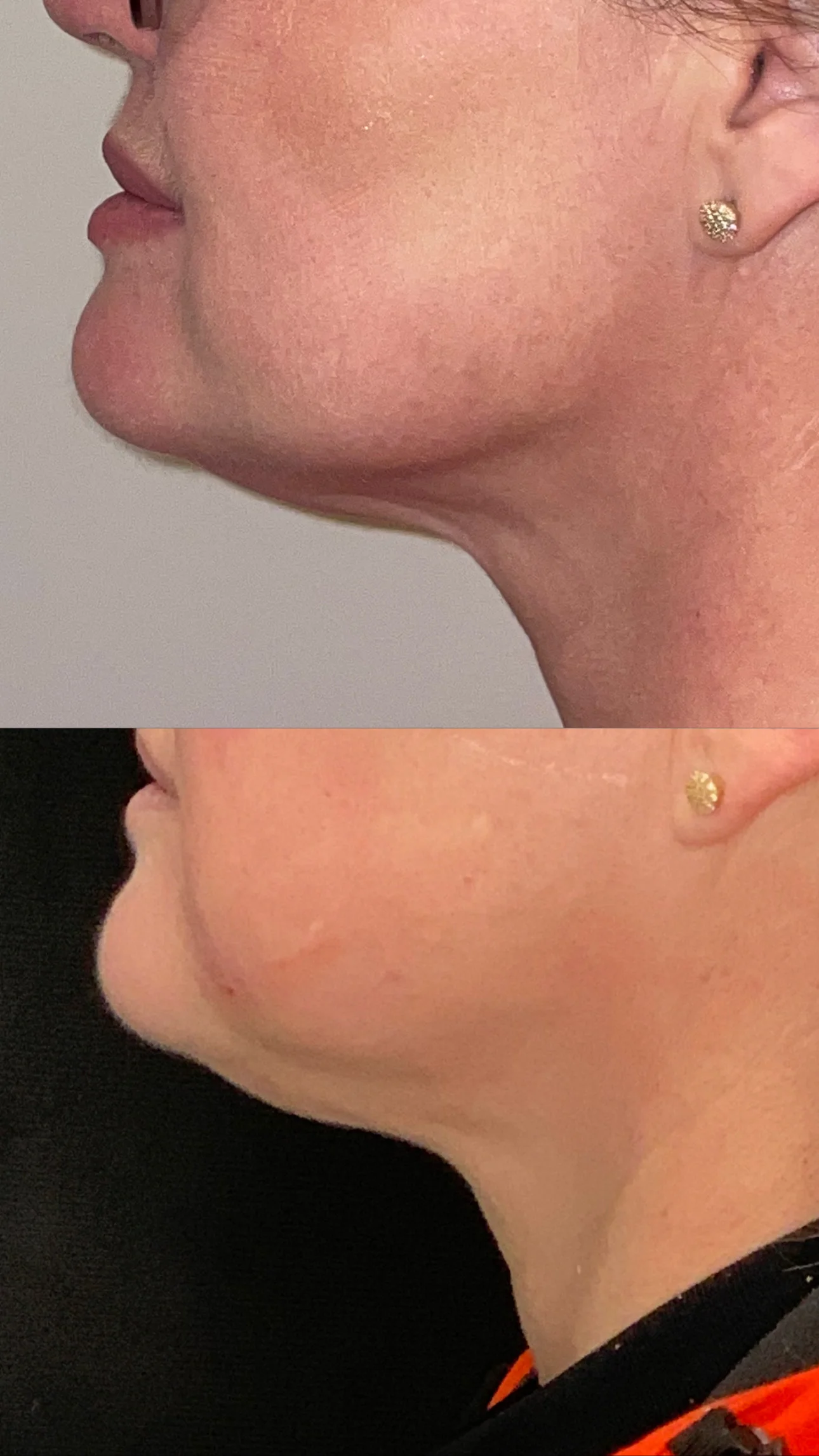 Antes e depois de contorno mandibular masculino em Curitiba