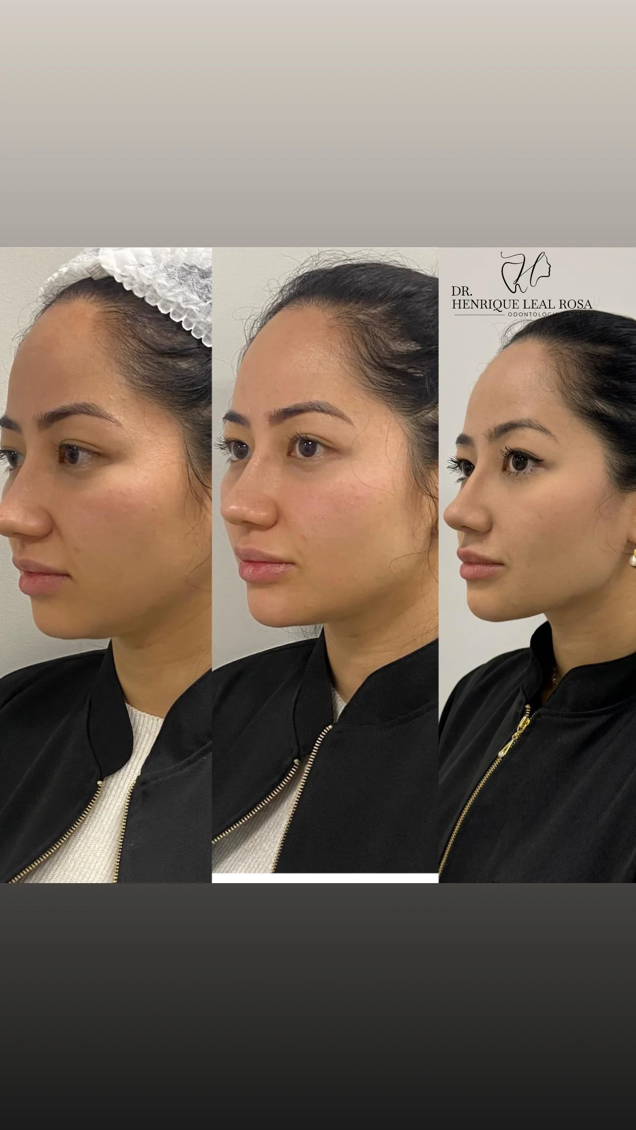 Antes e depois de harmonização facial feminina com naturalidade em Curitiba
