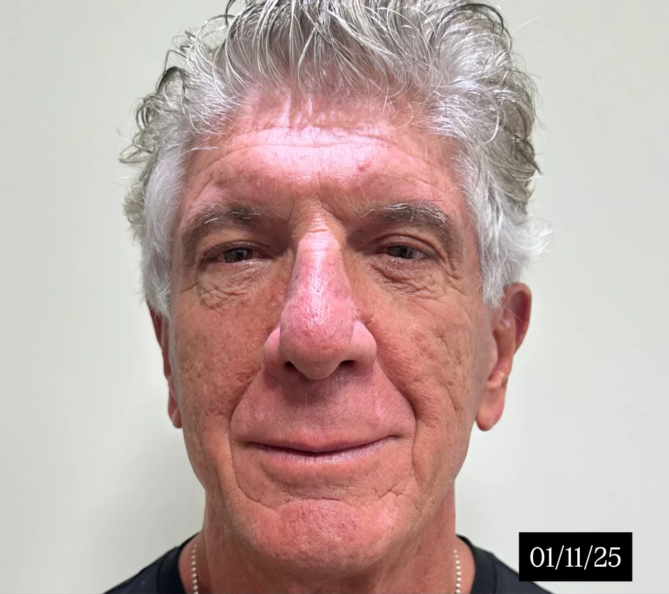 Contorno facial e pescoço rejuvenescidos com bioestimuladores