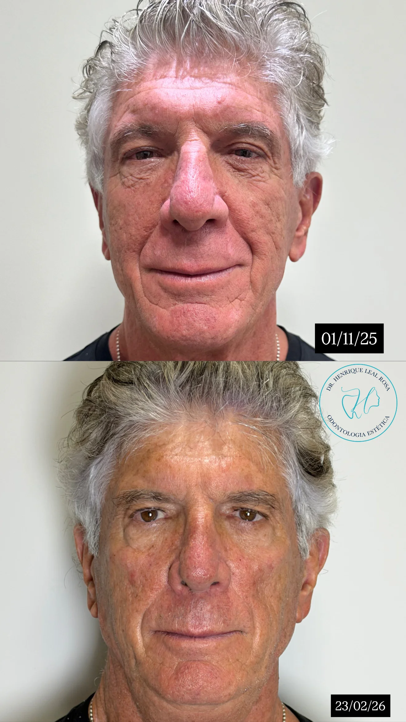 Caso de rejuvenescimento facial completo com fios de PDO e bioestimulador