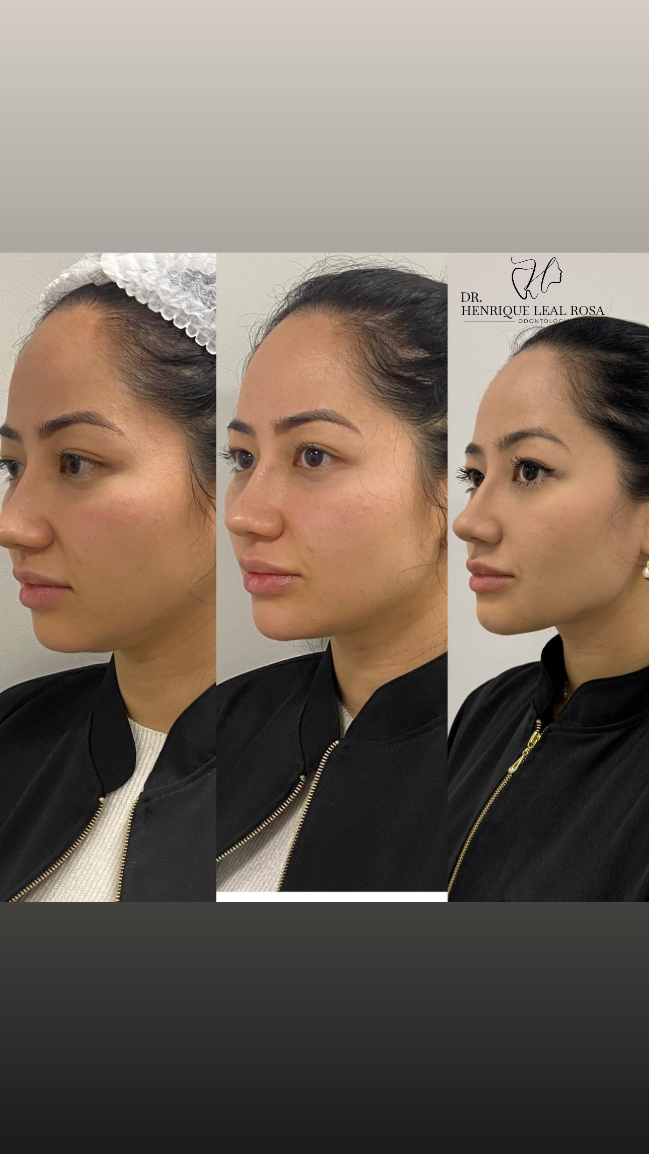 Harmonização Facial Completa - Antes e Depois