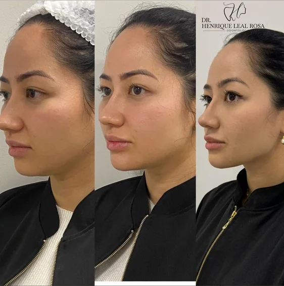 Perfil facial rejuvenescido no consultório do Dr. Henrique Leal