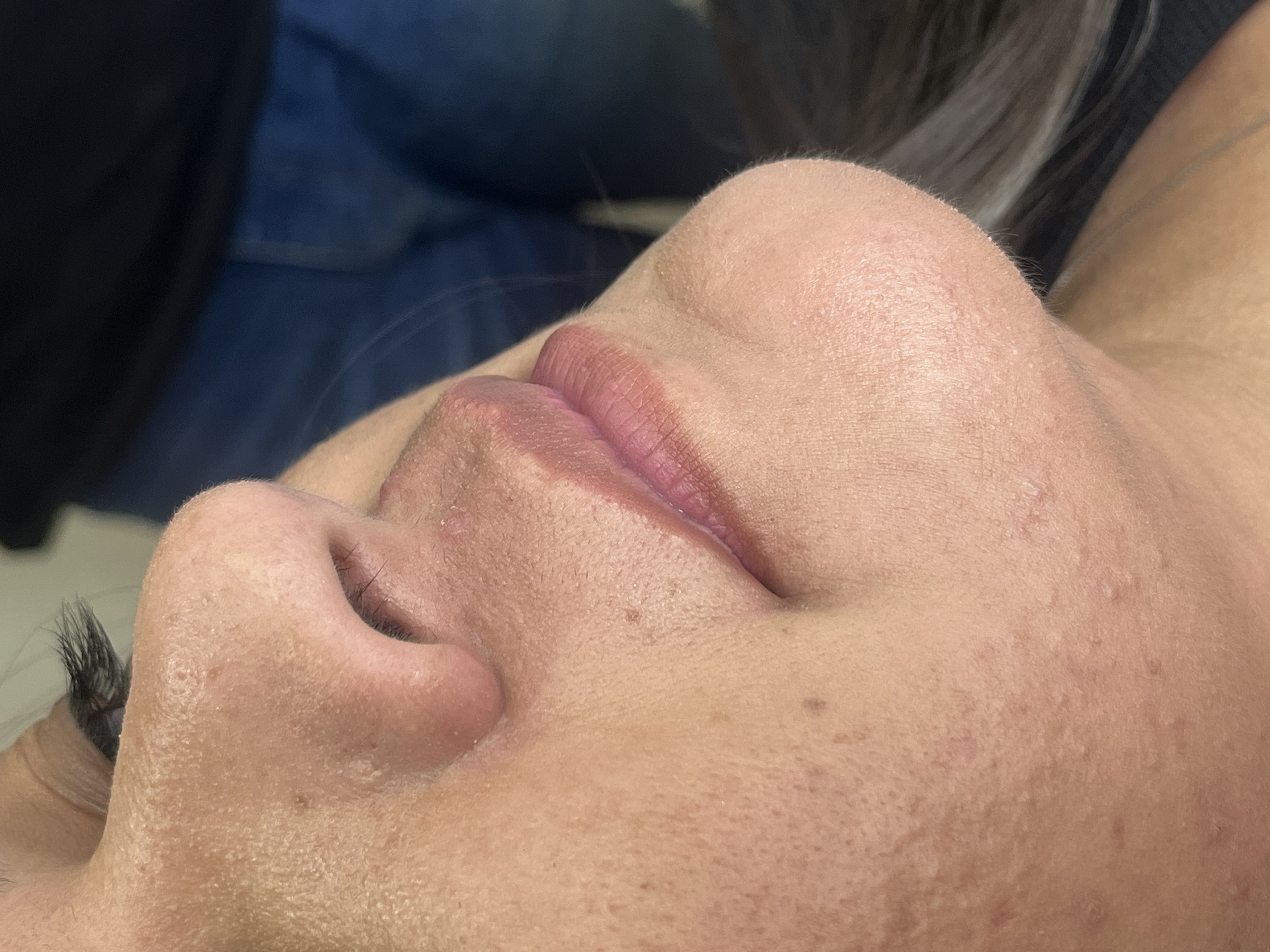 Antes — Preenchimento Labial