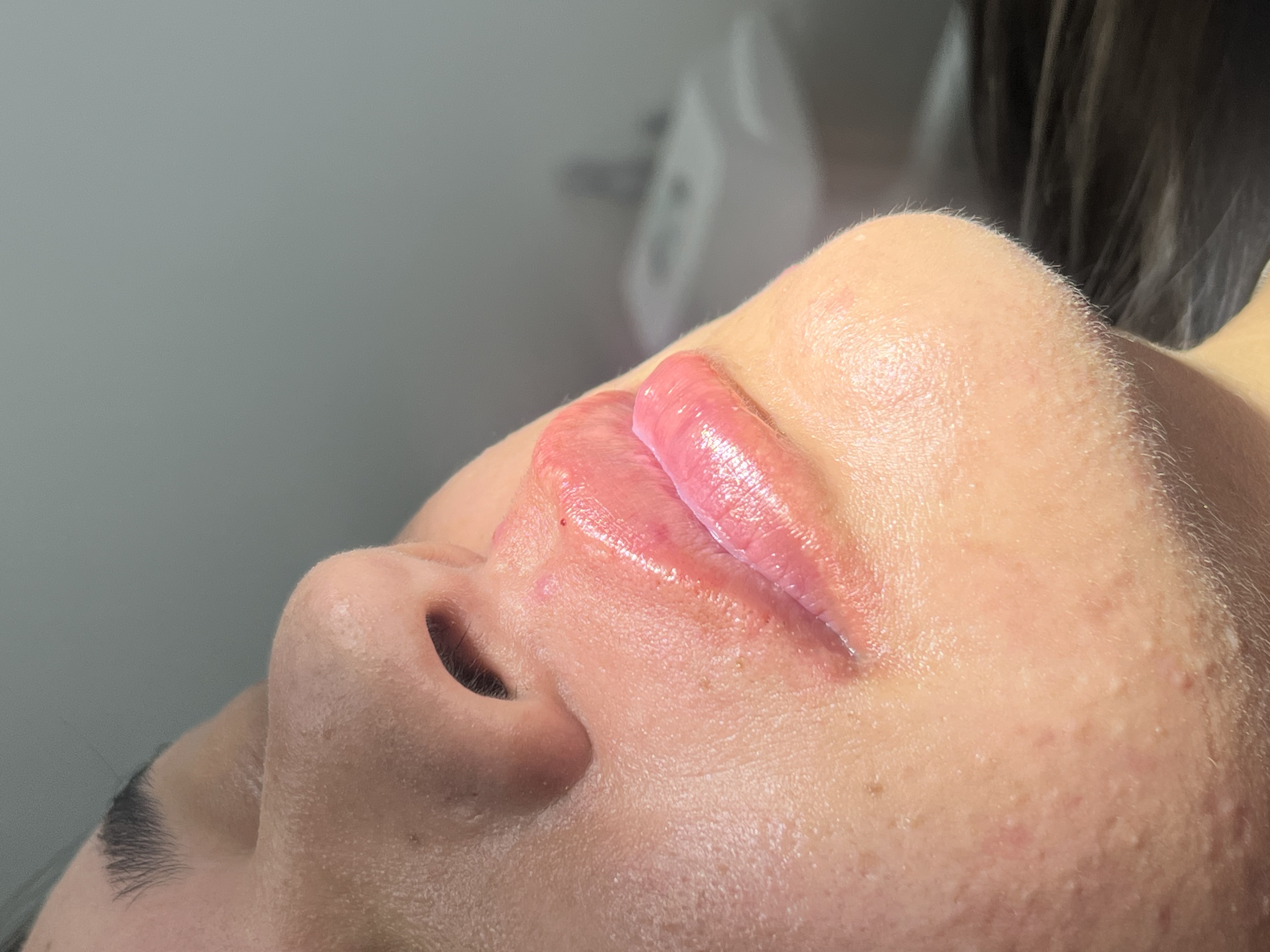 Depois — Preenchimento Labial