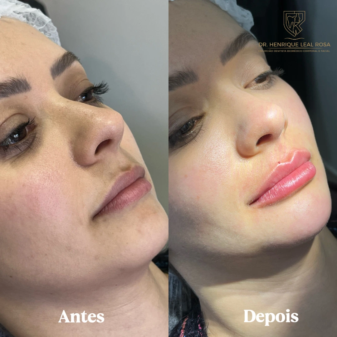 Cuidados Pós-Preenchimento Labial: Recuperação, Inchaço e Duração