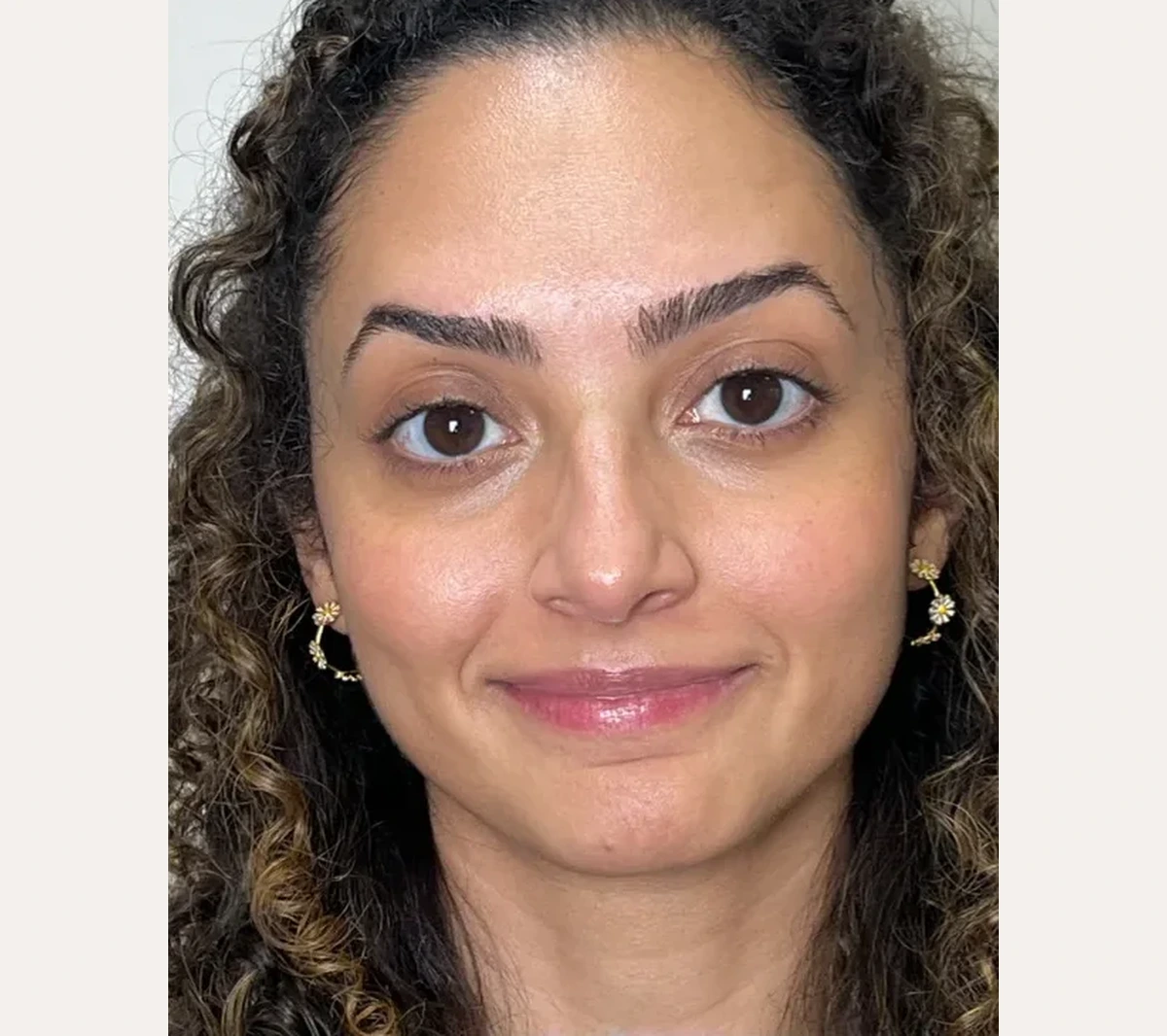 Resultado natural de botox preventivo na testa e olhos
