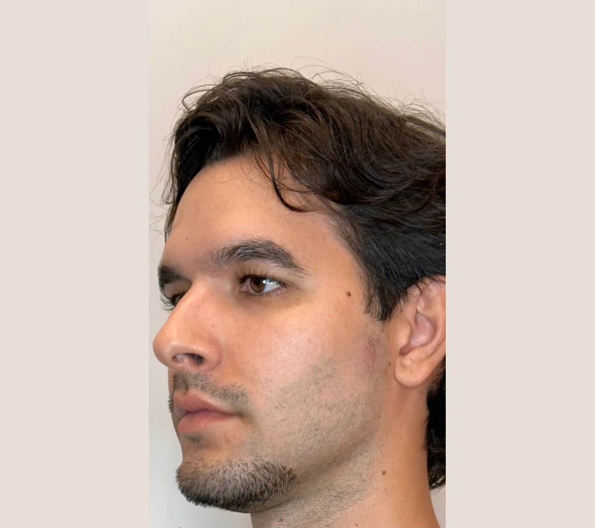 Harmonização Facial Masculina: Como Definir Mandíbula e Queixo sem Perder a Naturalidade