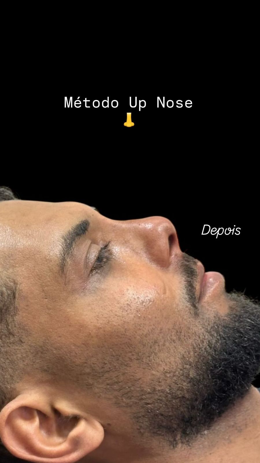 Antes — Rinomodelação