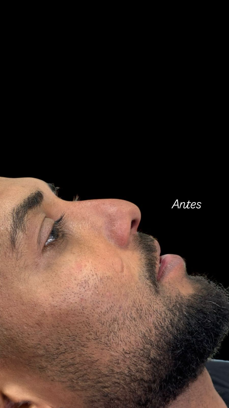 Depois — Rinomodelação